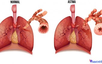 Bronxial astma zamanı adrenergik disbalans, xolinergik və sinir-psixi variantları
