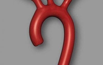 Qeyri-spesifik aortoarterit