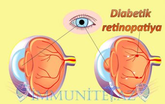 Diabetik retinopatiya.