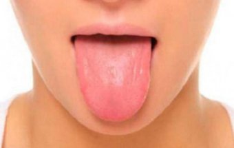 Dilin iltihabı – qlossit
