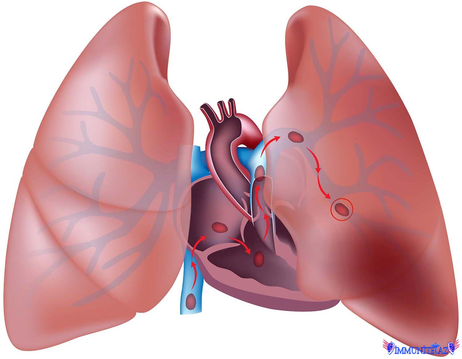 Ağ ciyər arteriyasının tromboemboliyası