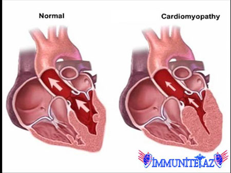 İşemik kardiomiopatiya