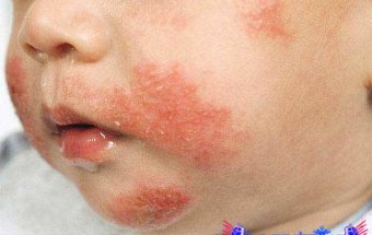 Azyaşlı, allergiyalı uşaqları necə qidalandırmaq lazımdır?