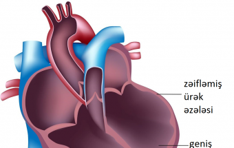 Dilatasion kardiomiopatiya