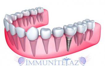 Dişlərin implantasiya metodları