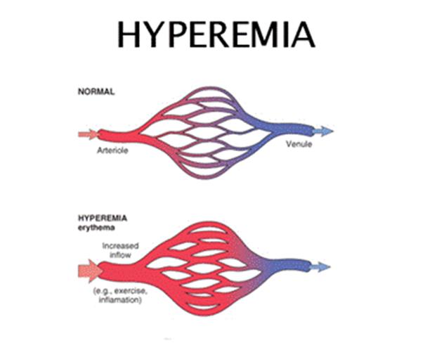 Arterial hiperemiya
