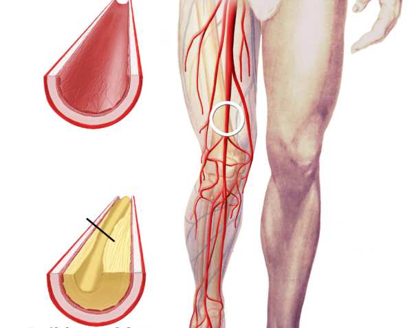 Aşağı ətraf arteriyalarının aterosklerozu