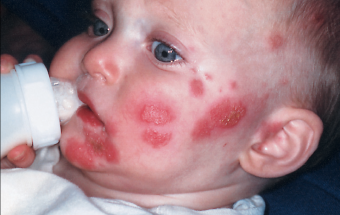 Yenidoğulmuşların herpes infeksiyası